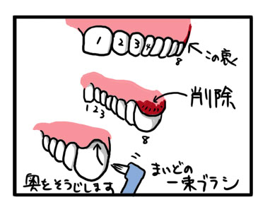 歯医者　舌　掃除　歯ぐき　腫れ　漫画　マンガ　体験