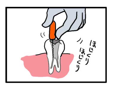 歯医者　治療　マンガ　漫画　インプラント　根管治療